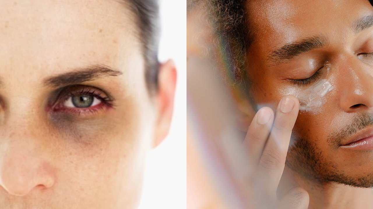 Dark Circles under Eyes : కళ్ళ కింద వలయాలు ఎందుకు వస్తాయో, ఎవరికీ ఎక్కువగా వస్తాయో తెలుసా??