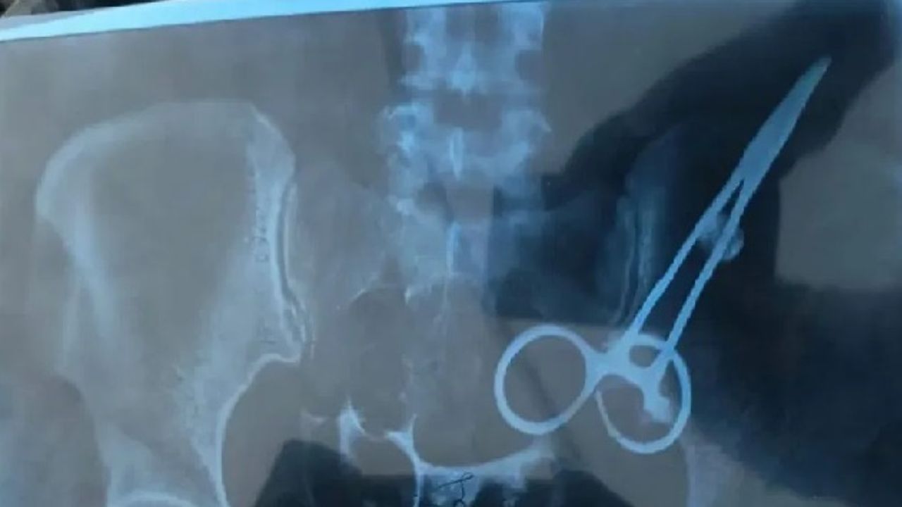 Doctors Neglect: ఆరేళ్ళ క్రితం మహిళకి ఆపరేషన్.. కడుపులోనే కత్తెర మరచిన వైద్యులు!